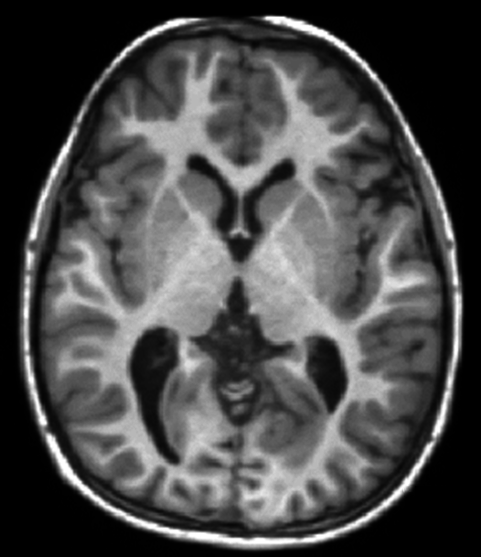 File:T1-weighted-MRI.png