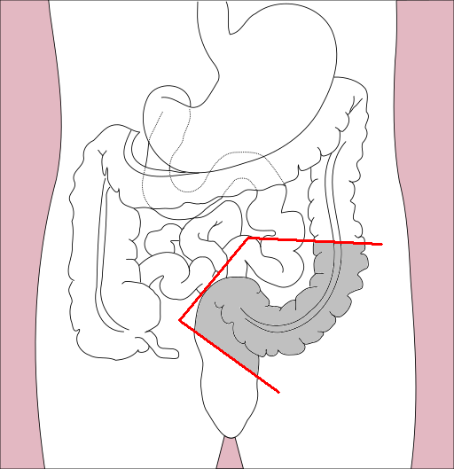 File:Sigmoidectomy.png