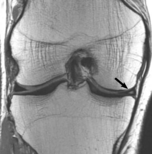 File:Proton density MRI of a grade 2 medial meniscal tear.jpg