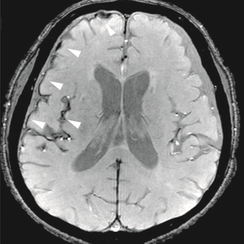 File:Effective T2-weighted MRI of hemosiderin deposits after subarachnoid hemorrhage.png