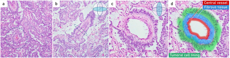 File:Histopathology of endodermal sinus tumor with Schiller–Duval bodies.png