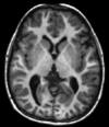 T1-weighted-MRI.png