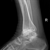 Lateral X-ray scan of ankle with secondary osteoarthritis