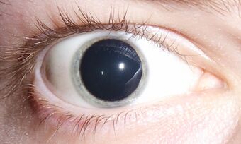 Dilated pupils 2006 (cropped 2).jpg