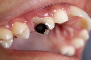 Dental Caries Cavity 2.JPG