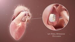 3D Medical Animation still shot of Left Atrial Appendage Occlusion