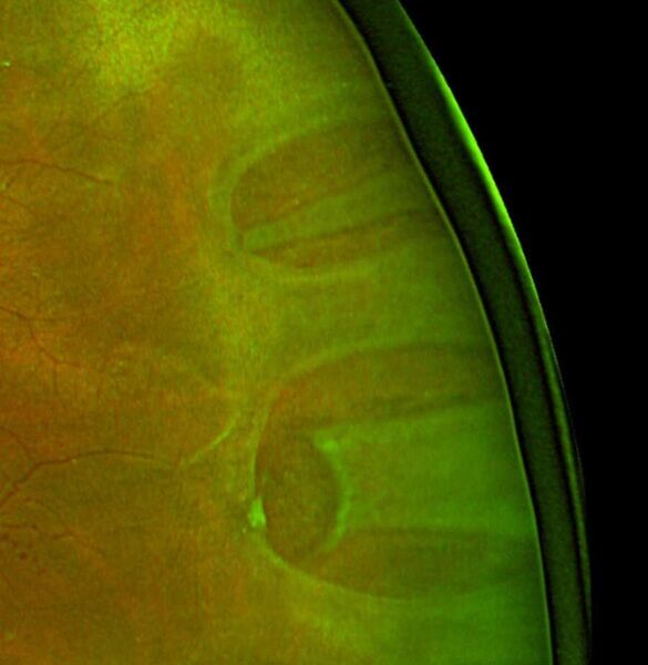 File:Rhegmatogene amotio retinae.jpg