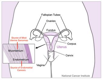 Uterus with Cancer Origins.jpg