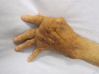 photograph of elderly hand depicting advanced rheumatoid arthritis