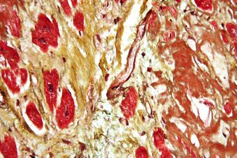 Cardiac amyloidosis very high mag movat.jpg
