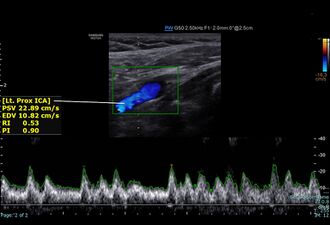 Left proximal internal carotid artery normal spectral doppler.jpg