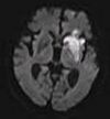 Cerebral infarction after 4 hours on DWI MRI.jpg