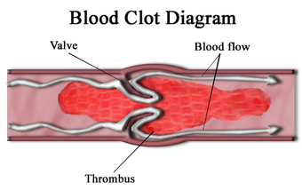 Blood clot diagram.png
