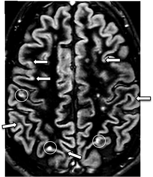 File:Axial DIR MRI of a brain with multiple sclerosis lesions.jpg