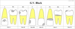 Chart showing digitally drawn images of caries locations and their associated classifications.