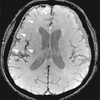 Effective T2-weighted MRI of hemosiderin deposits after subarachnoid hemorrhage.png