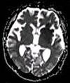 Cerebral infarction after 4 hours on ADC MRI.jpg